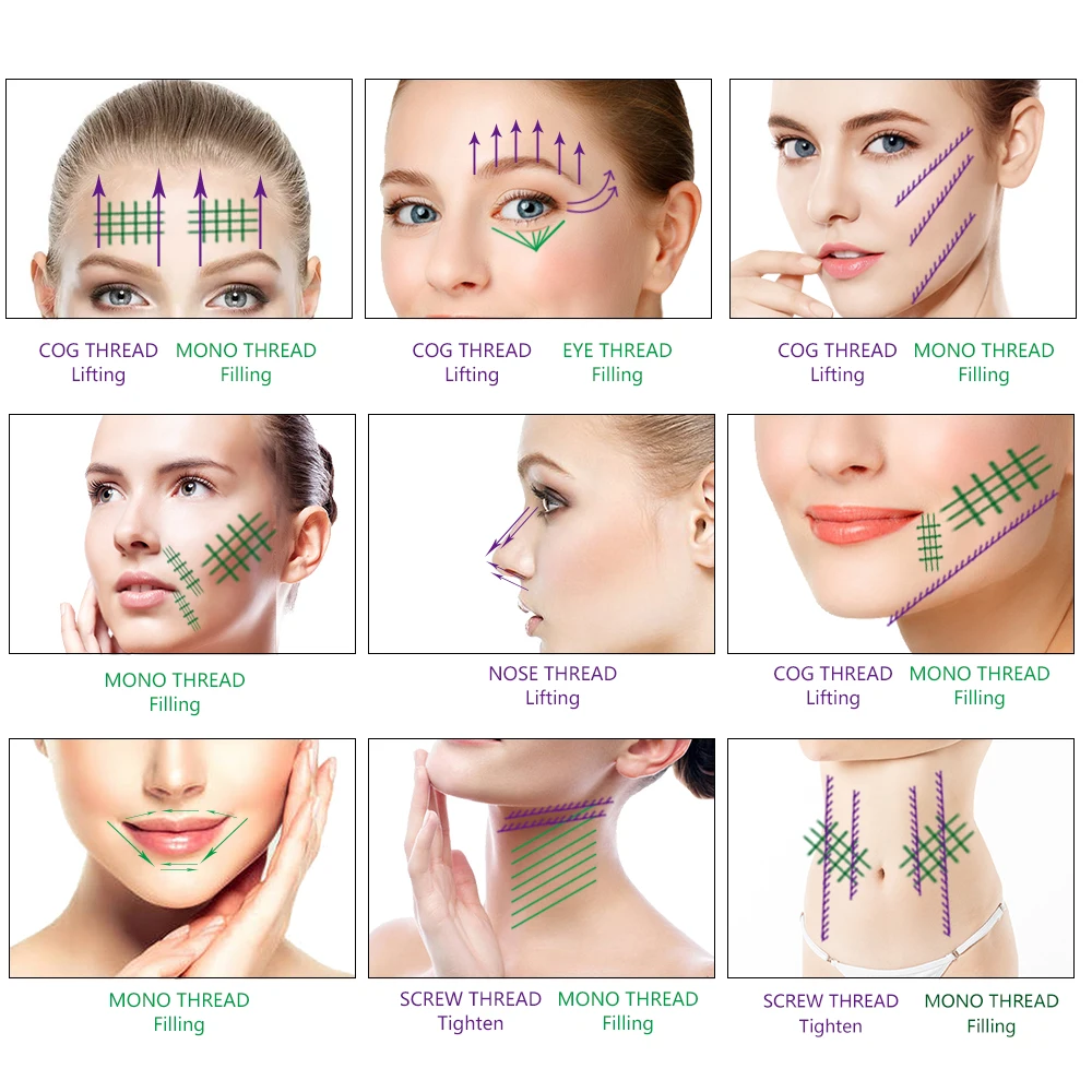 New Technology Pcl Type L Nose Cog Threads 21g 60mm For Nose Lifting