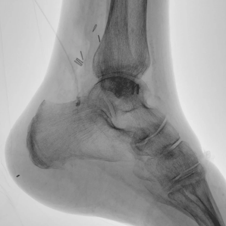 Manufacture price 5kw fluoroscopy radiology c arm x ray machine