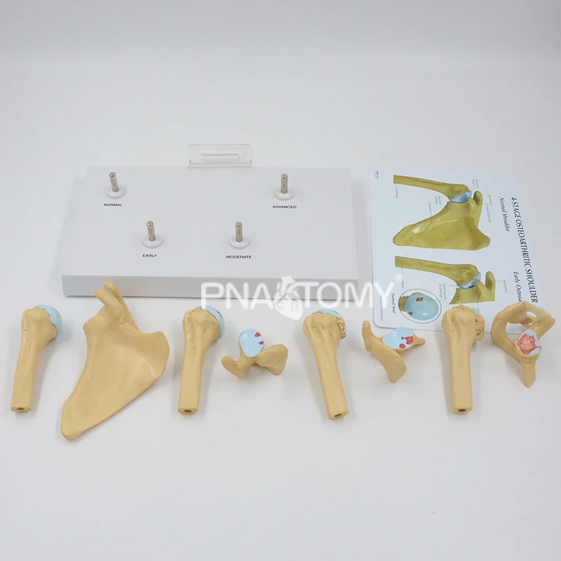 4-STAGE OSTEOARTHRITIS (OA) SHOULDER ANATOMY MODEL HUMAN SKELETON ANATOMICAL MODEL TEACHING RESOURCES EDUCATIONAL EQUIPMENT