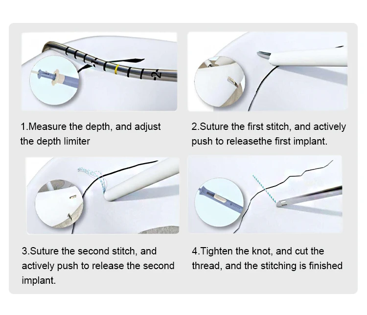 Sports Medicine Orthopedic trauma surgery Meniscal Repair Meniscal Suture Meniscus Needle Fast Fix Meniscal Repair System