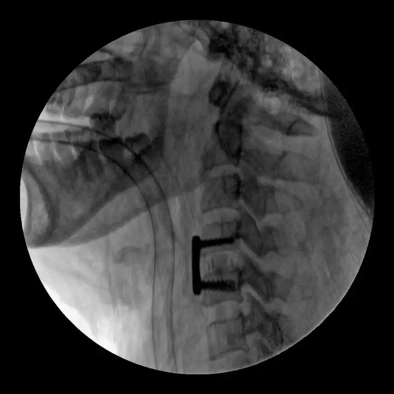 PLX 7200 3D image intensifier High Frequency dental digital sensor x-ray system