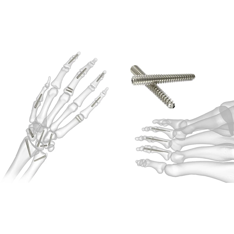 Meditech  Medical Titanium Orthopedic Implants Cannulated Herbert Screw Headless Cannulated Screw With Price