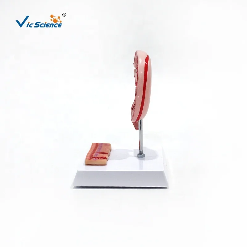 medical anatomical model Hot quality BN Plastic Stomach diseased  Gastric ulcer  anatomy model medical science education model