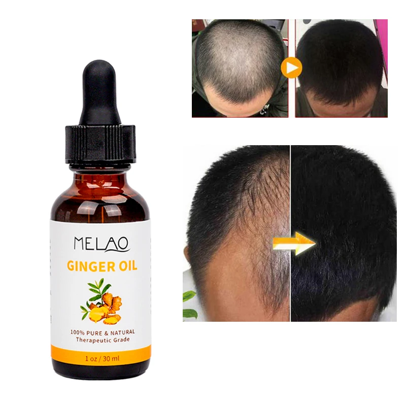 30ML 100% pure Natural Ginger Germinal Oil Hair Growth Essential Oil Liquid ginger oil hair treatment for hair care