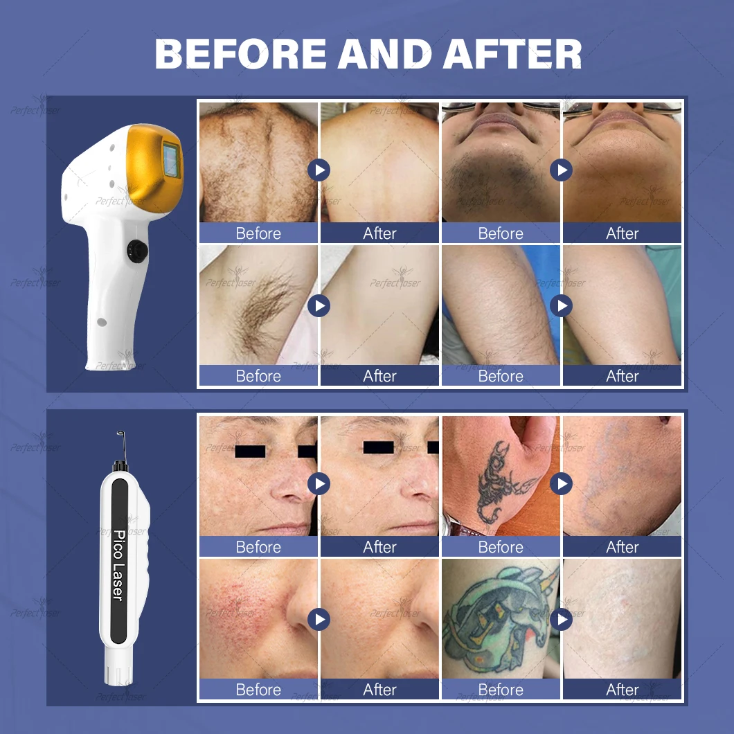Perfectlaser Multifunctional nd yag Pico Laser Price 2024 New Portable  Ice 755nm 1064nm 808 nm Diode Laser Hair Removal Machine