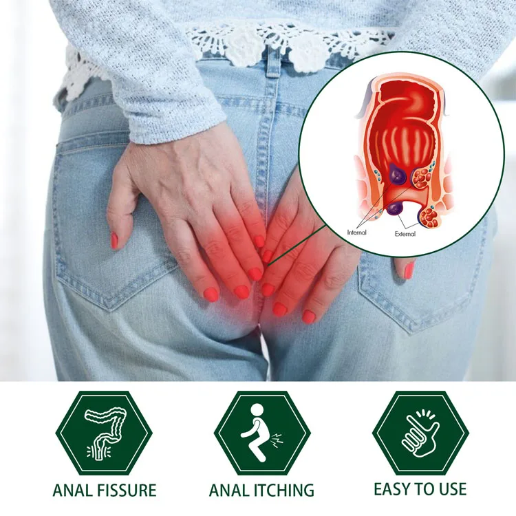 New Arrival Healthy Product Hemorrhoid Ointment No Harmful Addition Mild Non-irritation Hemorrhoid Cream