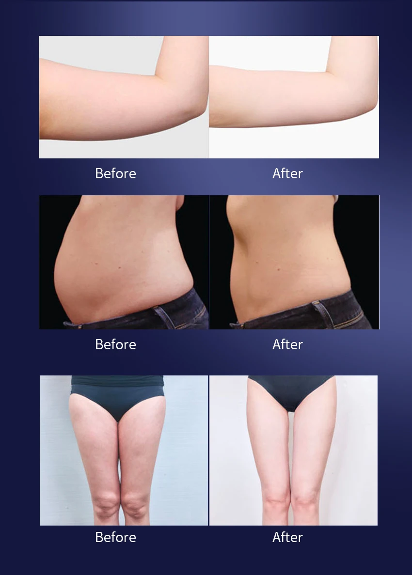 5 in 1 40k Radio frequency cavitation skin tightening ultrasound Laser Lipolaser Body Molding Massage slimming machine