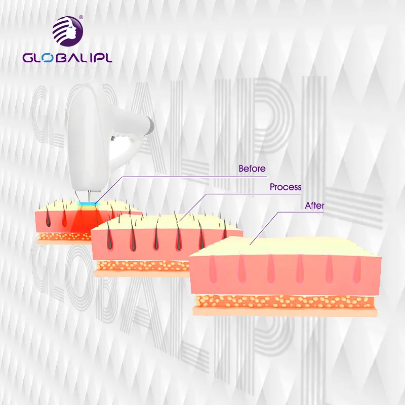 Fast Permanent 808nm Diode laser painless hair removal machine