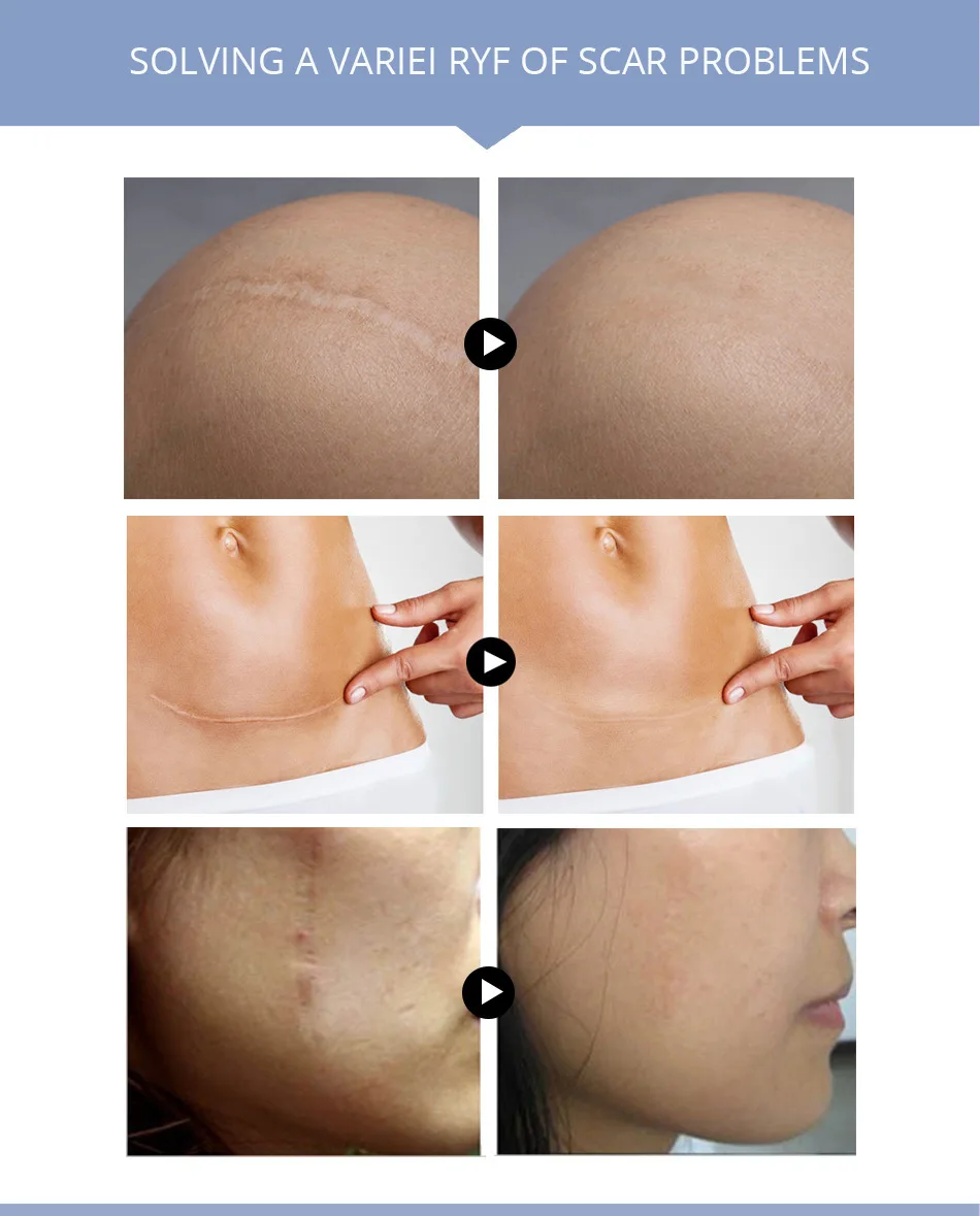 striae gravidarum cream