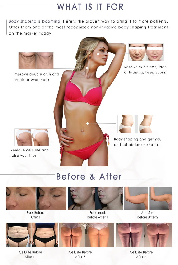 Velashape5