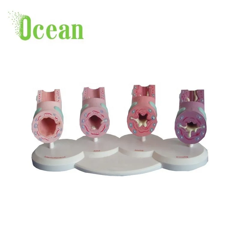 Модель обычной астматовой бронхиолы, трахеальная патология, медицинская модель для демонстрации прохождения рекламы