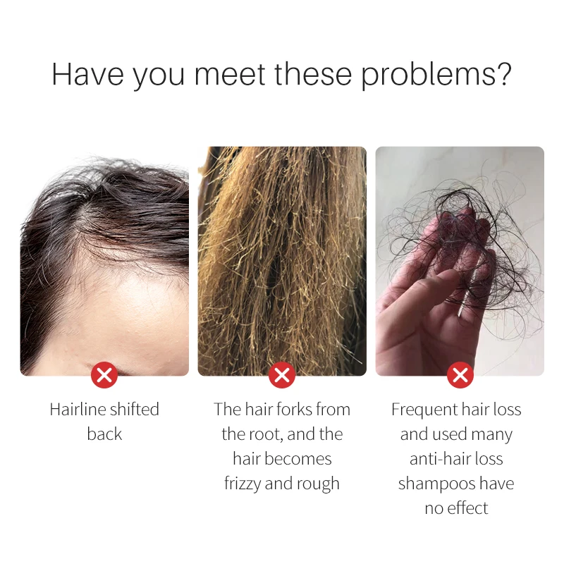 Wholesale Organic Fast Hair Loss Care Growth Treatment Bald Hair Rice water For Hair Growth