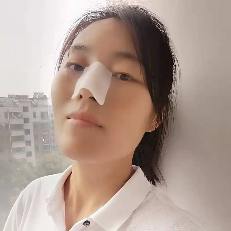 Thermoplastic Nasal Splints Post Nose Surgery Fracture Nose Fixation