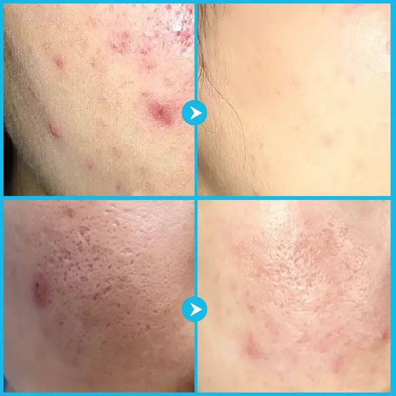 Effective Herbal Shrink Pores Moisturizing Whitening Remove Pimple Cream Face Anti Acne Removal Cream