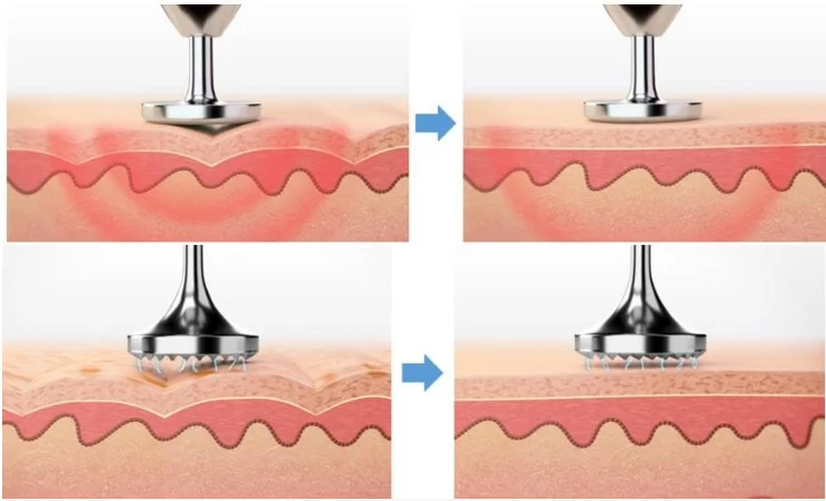 3 in 1 Handheld Massage Acupuncture Magic Pen With Needles For Spot Removal Tattoo Removal