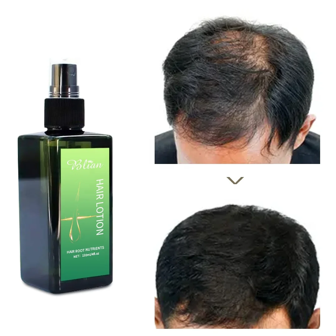 Loss Hair Treatments Root Nutrients Spray Lotion