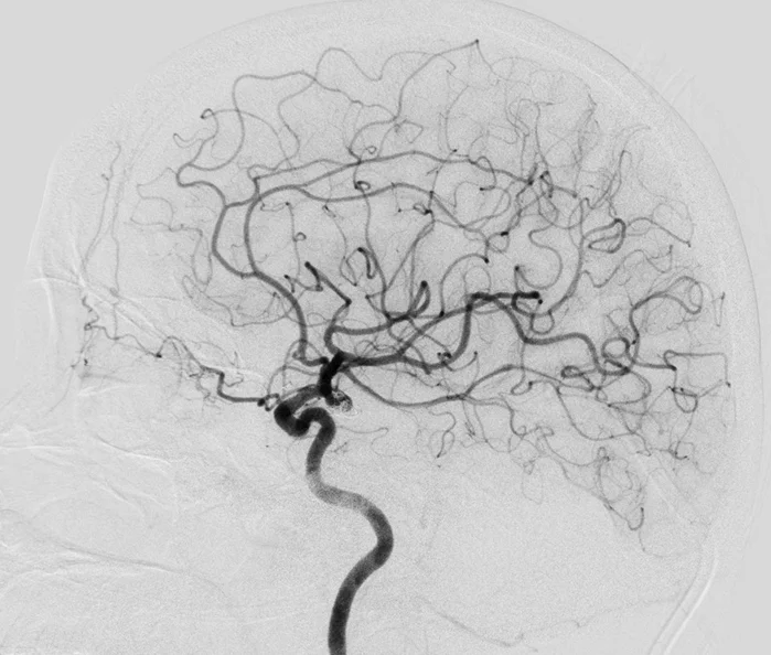 C arm x ray machine for neuro cardiac peripherial  angiography machine with liquid metal bearing x ray tube