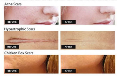 2024 BEST Source manufacturer  Fractional Laser Co2 Vaginal Mini  CO2 Laser Machine removal machine co2 fractional laser machine