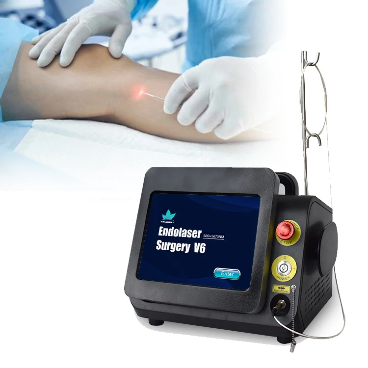 Triangel Professional Varicose Veins Removal Treatment Radial 360 degrees Optical Fibers Diode Laser