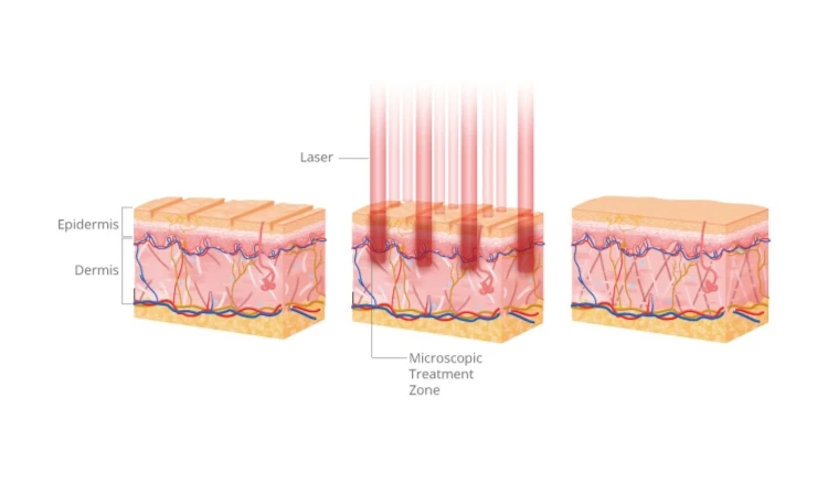 GSD 1550nm Fractional Laser Machine /Wrinkle Reduction /Scar Removal/Skin Rejuvenation