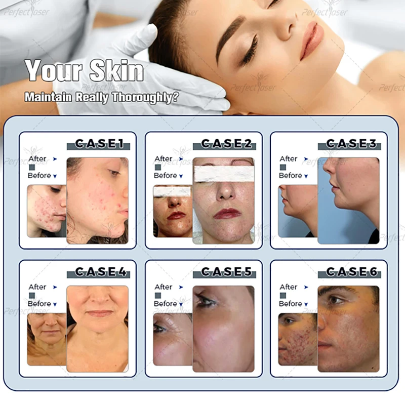 12 In 1 Hydra Dermabrasion Facial Peel Machine Hydra Dermabrasion Microdermabrasion Device