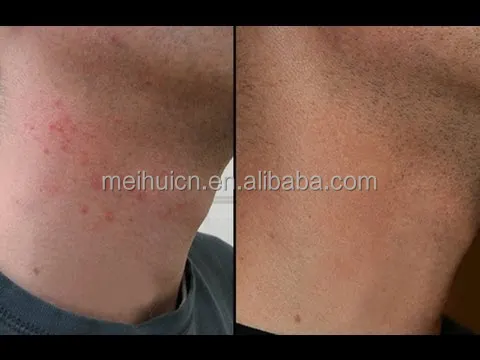 Private Label Best Ingrown Hair Treatment Cream Razor Bump Burn Remover After Shaving Soothing Gel