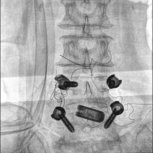 Advanced Mobile C arm x ray system with dual touch control