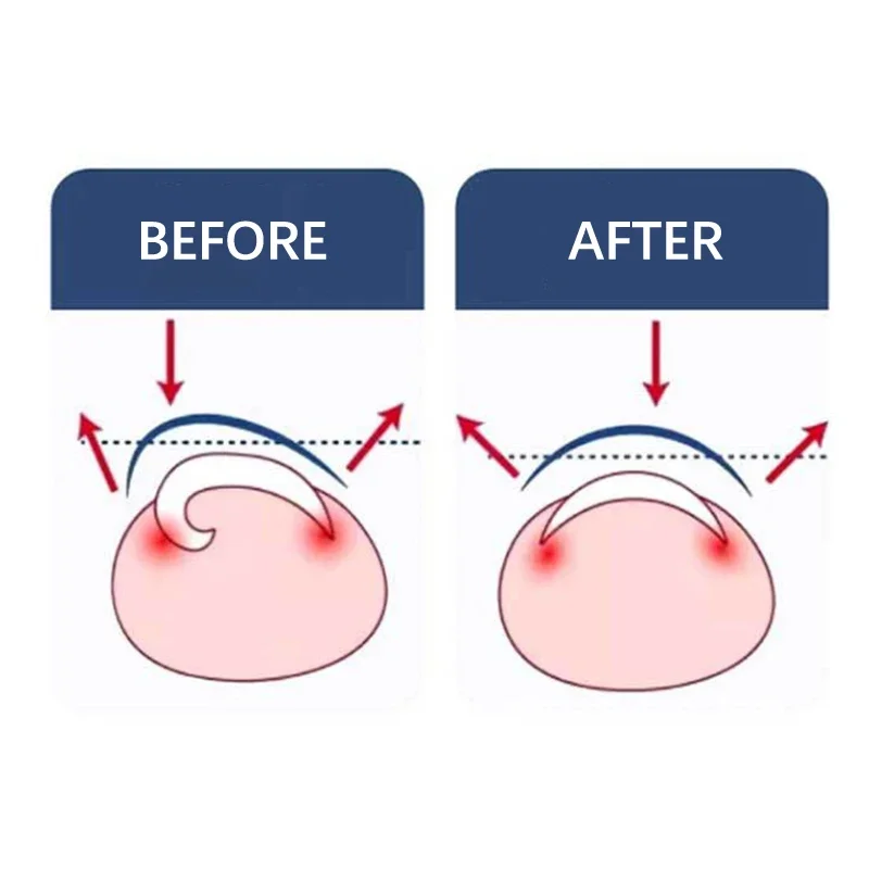 Ingrown Toenail Corrector Tools Pedicure Recover Toe Nail Treatment Professional Correction Foot Care