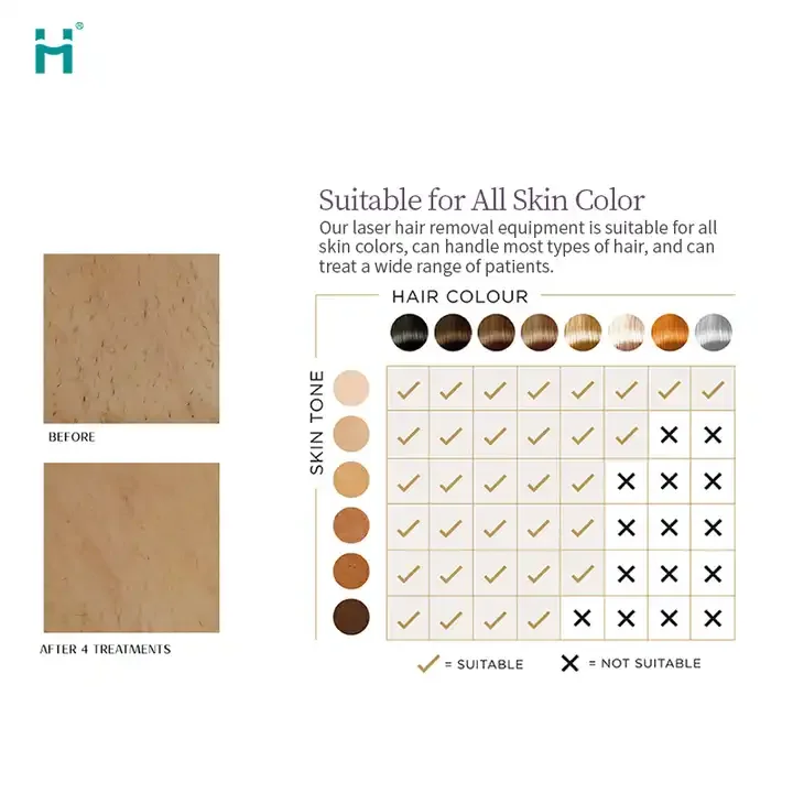 2 in 1 diode and picosecond laser picosecond q-switched laser tattoo removal machine diode laser hair remowal with picosecond