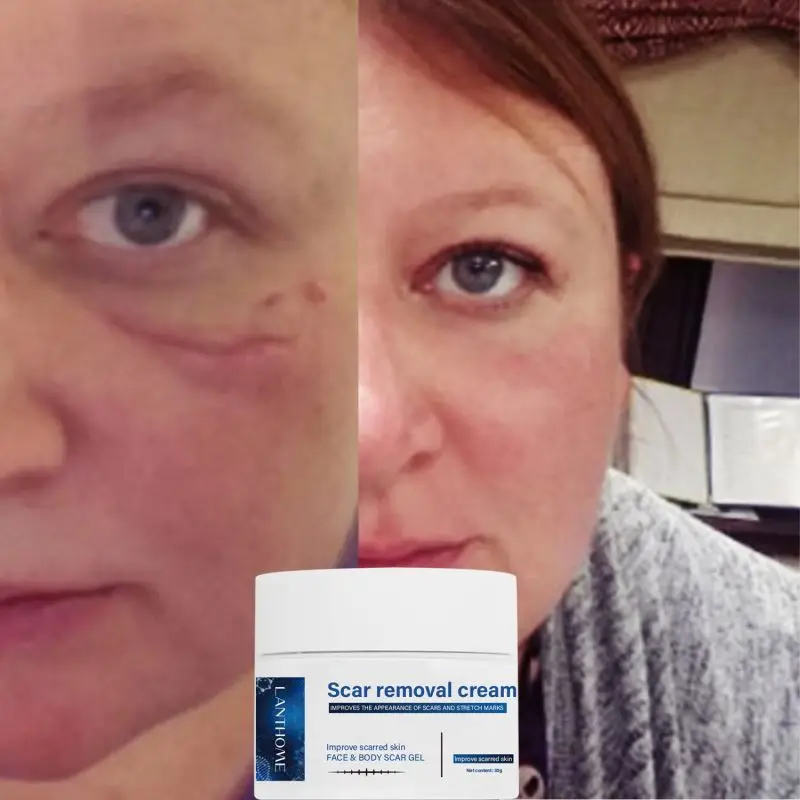 30g Old And Dark Spot On Leg Removal Cream Remove Postoperative Effectively Prevents Scar Proliferation After Surgery