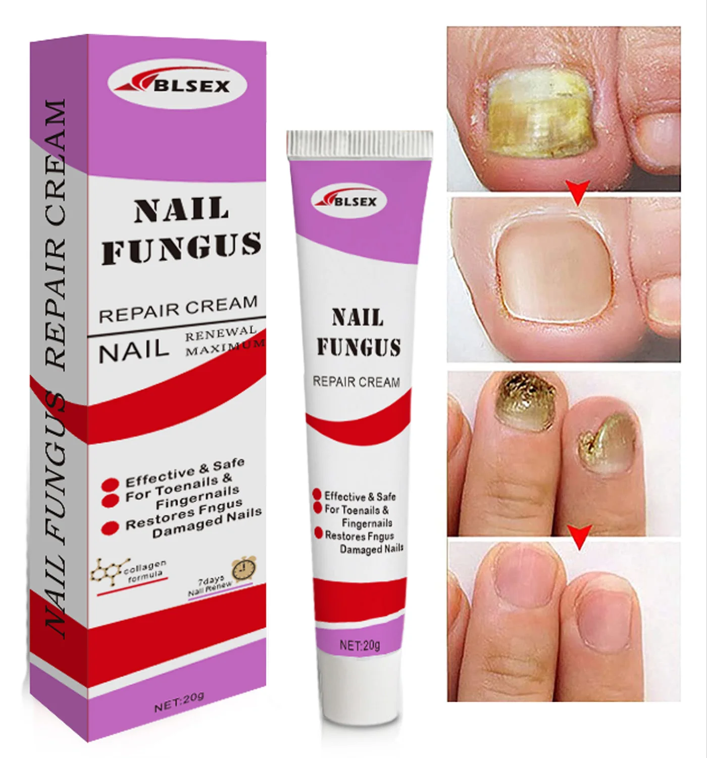 Nail Fungus Removal Cream Onychomycosis Fungal Nail Treatment Paronychia Anti Infection Feet Toe Fungal Nail Care Ointment