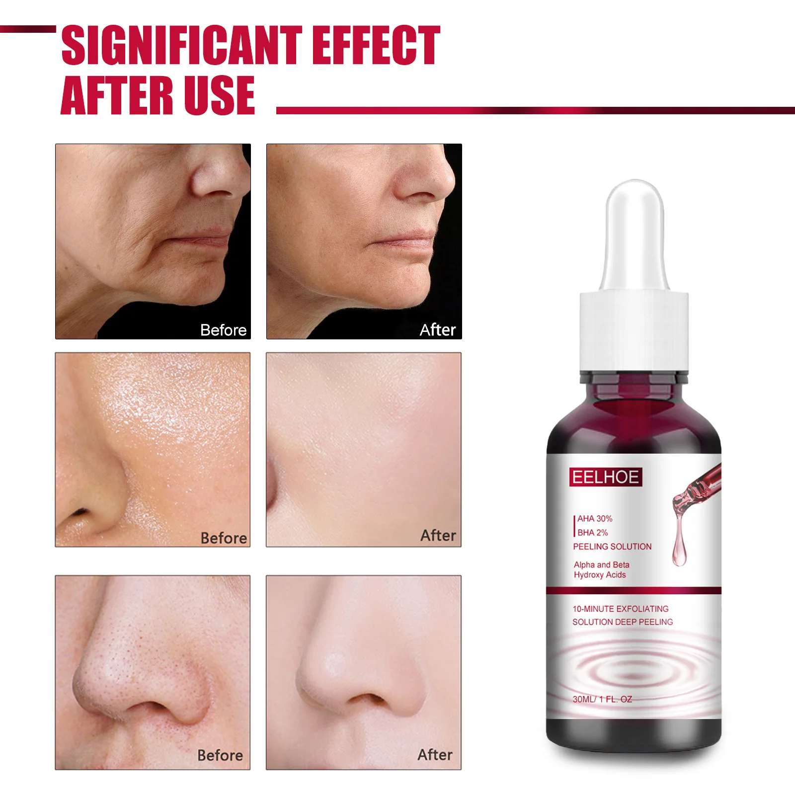 Salicylic Acid Essence Exfoliating mouth closing Blackheads pore narrowing essence