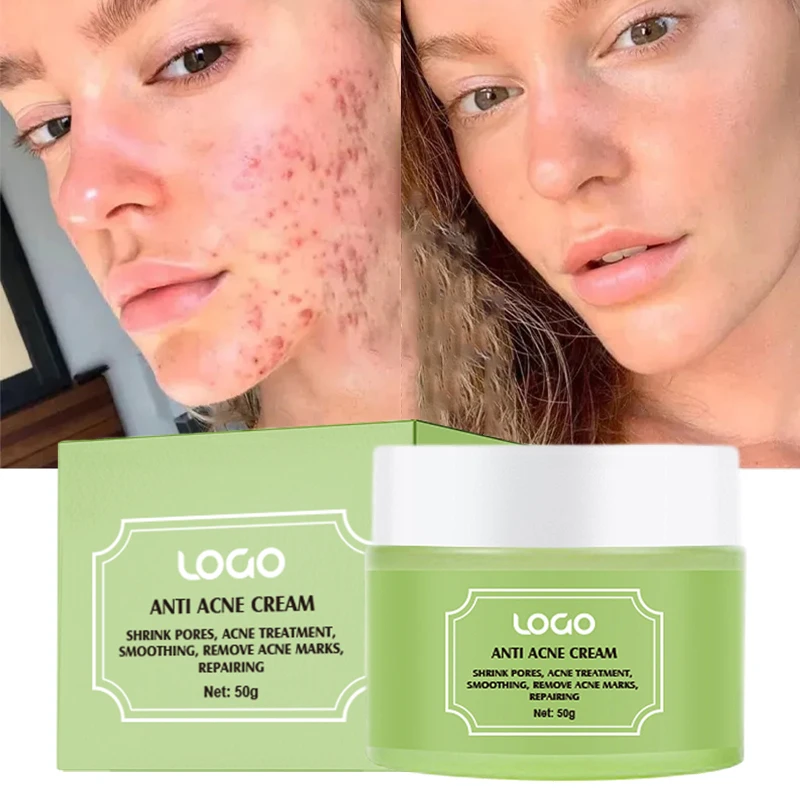 OEM Private Label Organic Tea Tree Acne Scar Whitening Repairing Face Cream for Acne