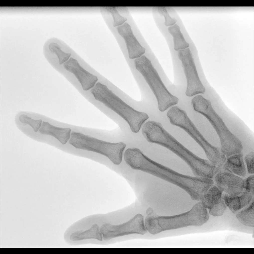 X-ray C-arm machine PLX118F what is c arm x ray machine