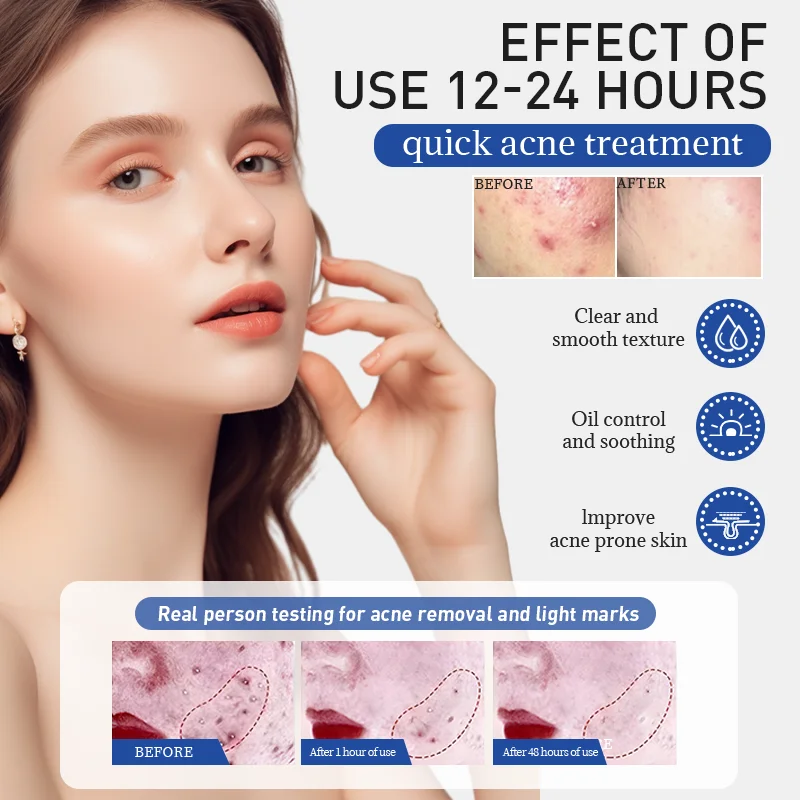 Сыворотка для лечения акне