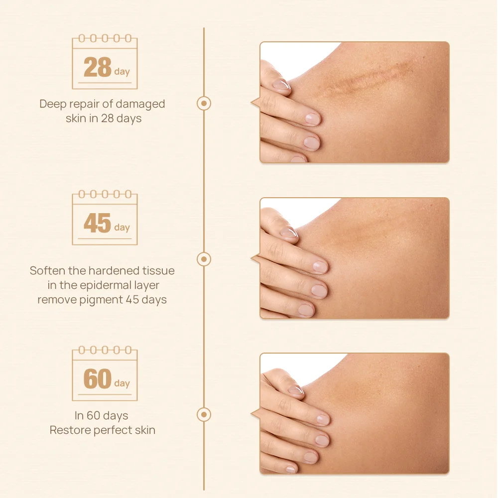 LANBENA Private Label Scar Removal Serum Stretch Mark Oil Acne Mark Repair Skin Care