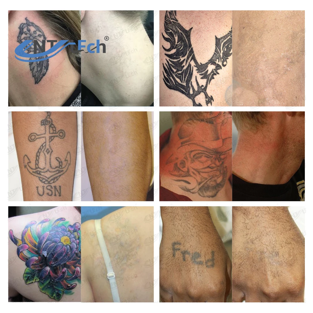 Professional manufacturer laser q switch nd yag laser tattoo removal device