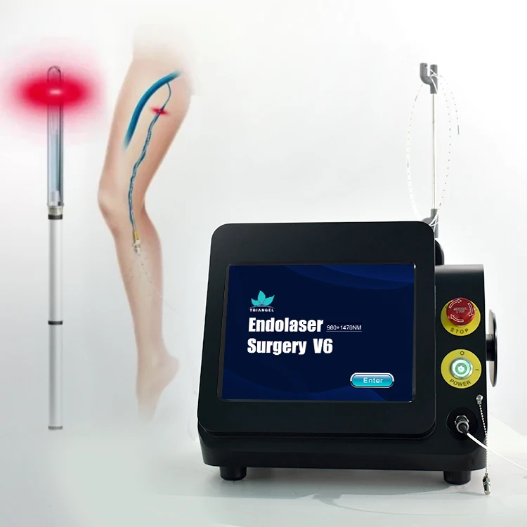 Triangel Professional Varicose Veins Removal Treatment Radial 360 degrees Optical Fibers Diode Laser