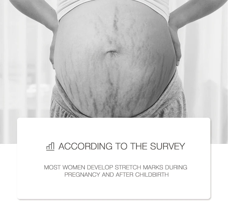 Essing Newest Innovation No-surgical For Beauty Center Stretch Mark Removal Machine