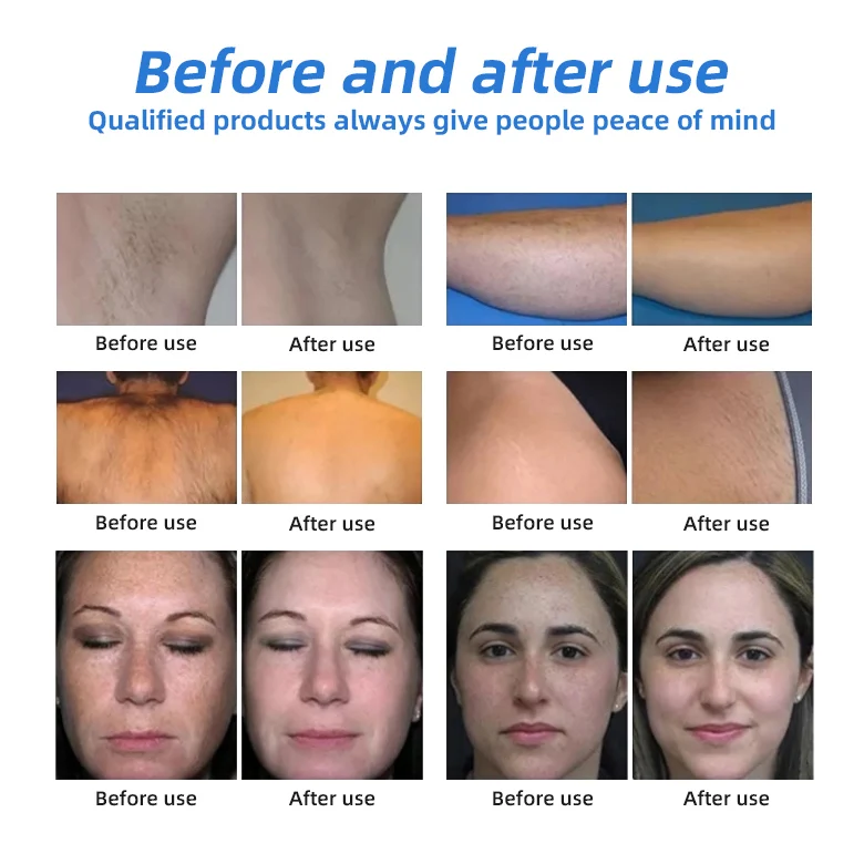 wholesale Beauty Salon Equipment Best Ipl Laser Hair Removal Price Laser Hair Removal equipment