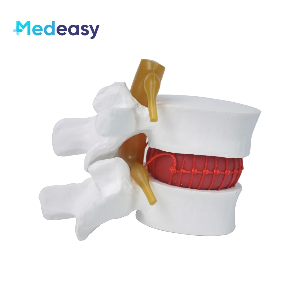 Lumbar disc herniation model, diseased spine model