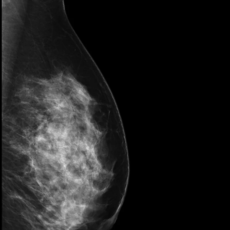 Careview 750M mammography flat panel detector price