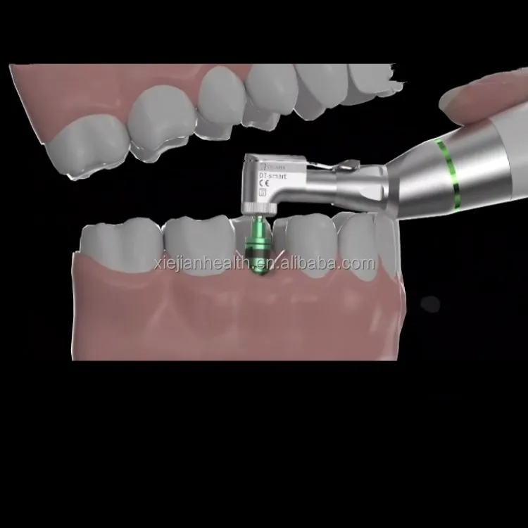 cordless implant (6).jpg