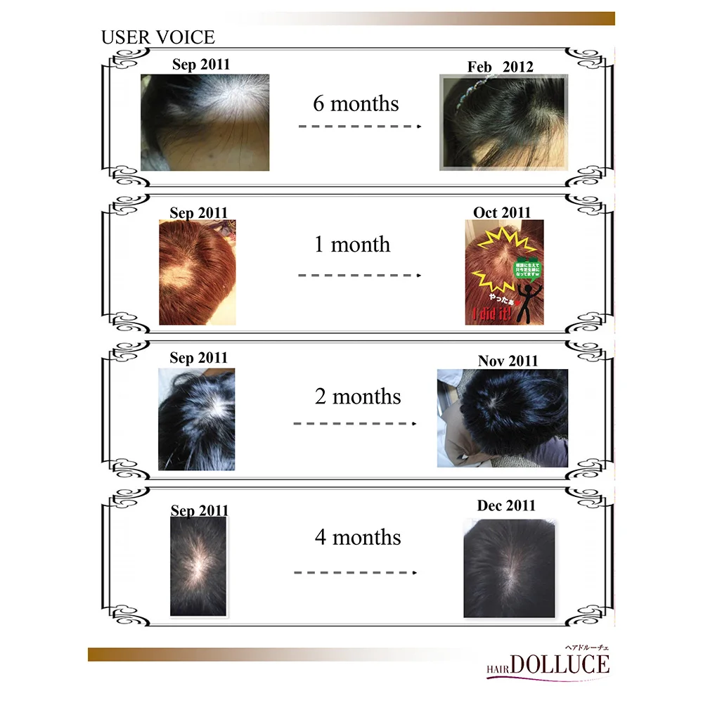 Preventing osteoporosis King Agaricus vitamins hair growth supplement