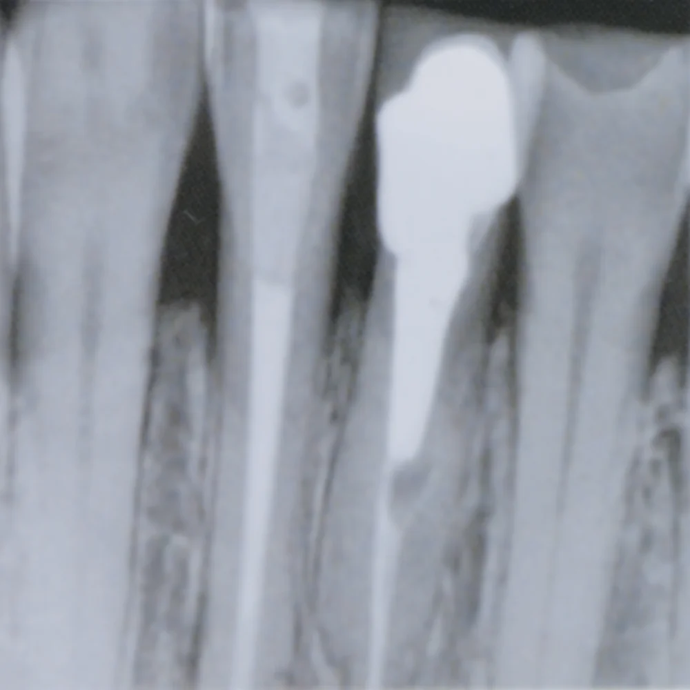 Portable Dental Equipments Remote Control Wall Mounted Panoramic X-Ray Unit Medical Dental X Ray Machine