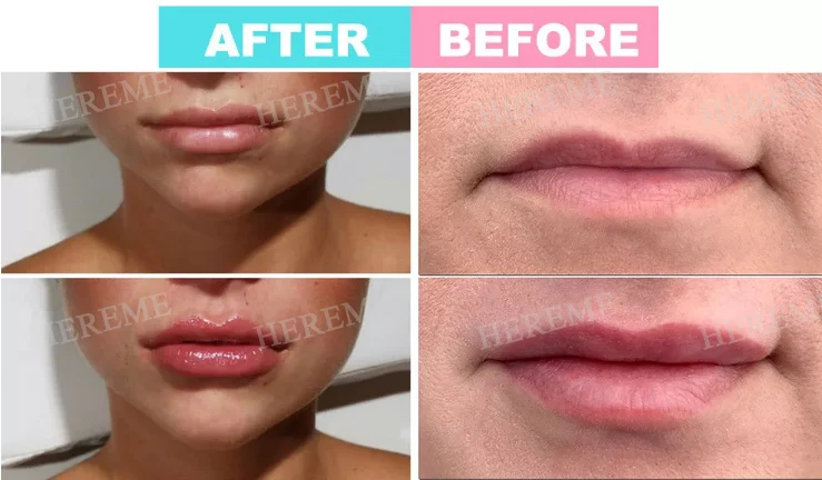 Heremefill Newest Hyaluronic Pen High Pressure 2 in 1 Syringe Hyaluronic Pen/Needle Free Very Cheap Hyaluronic Pen Supplier