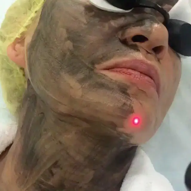 Mini Nd Yag Laser Type and Yes Q-Switch nd yag laser tattoo remove carbon peeling machine