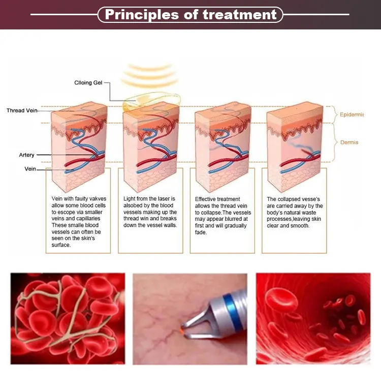 single-980nm-laser2-(5)_01
