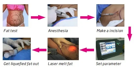laser liposuction surgery mini-invasive laser surgery melting fat slimming lipolysis laser