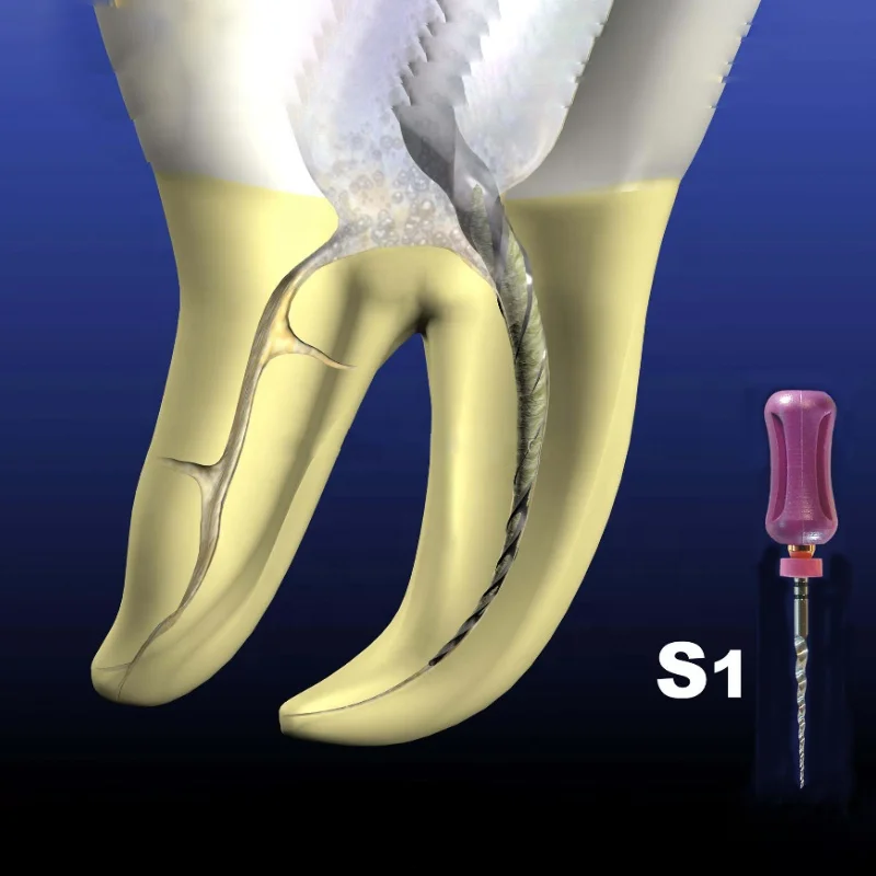 Engine use Niti Flexi Flexible Blue Super Endo Files for curved root canal